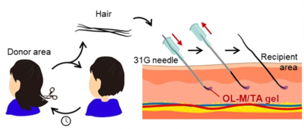 A Schematic of New Hair Transplantation Procedure